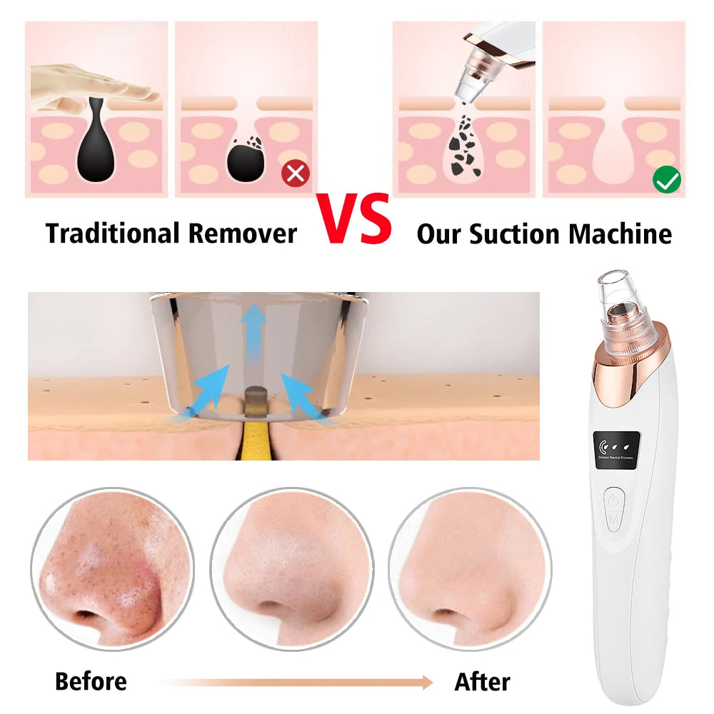 5-in-1 Electric Blackhead Remover Vacuum | Deep Pore Acne & Oil Suction Face Cleaner